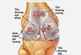 Thoái hóa khớp gối: Nguyên nhân và biện pháp khắc phục hiệu quả, an toàn