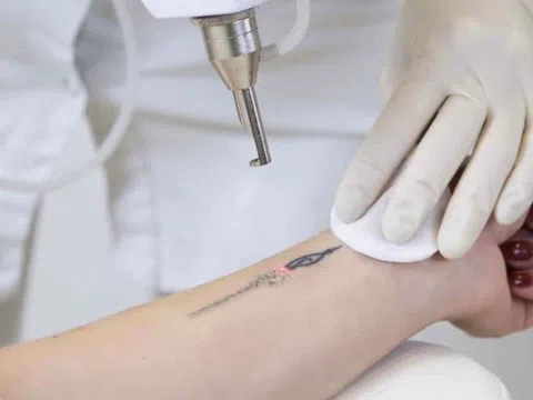 Xóa xăm laser có hiệu quả không? Giá bao nhiêu?