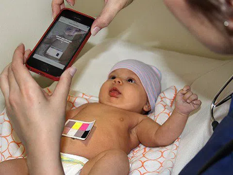 Ứng dụng điện thoại giúp chẩn đoán bệnh vàng da